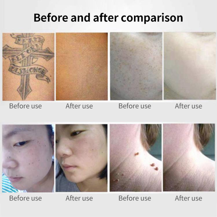 AA-A401 Portable Laser Beauty Instrument Mole Removal Freckle Removal Beauty Laser Pen, Red Light Plug-in, Blue Light Plug-in