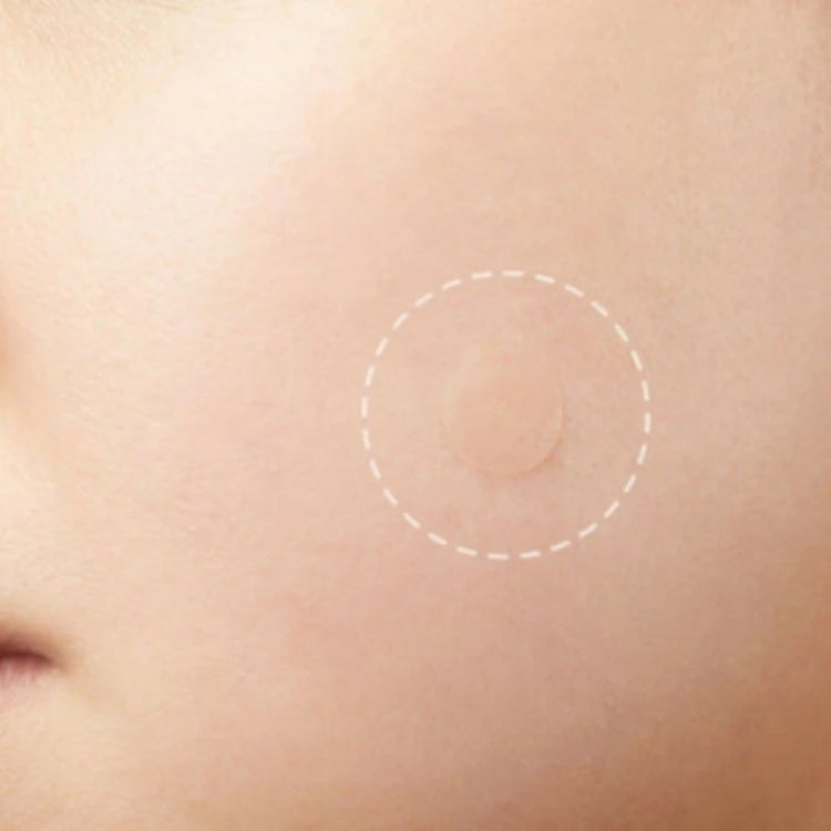 3 PCS Acne Tool Set Treatment Acne Scar Pimples Sticker