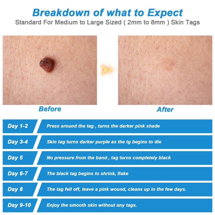 2 IN 1 Auto Skin Tag Remover Device Adult Mole Wart Remover Face Care Beauty Tools, 2 IN 1 Skin Tag Remover